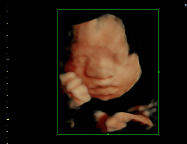 3D ultrasound image at 29 weeks